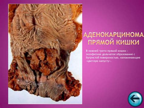 Патоморфология опухолевого роста. Терминология и номенклатура ...