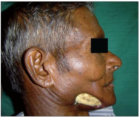 Osteoradionecrosis with exposed mendible