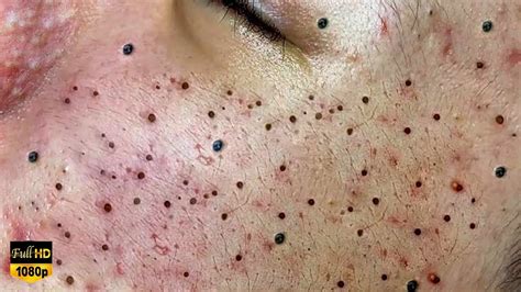 Experts Warn: This Unbelievable Blackhead Removal 2024 Trend is Dangerous! - 3ojizjl