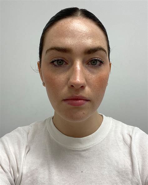 Hyaluronic Acid Fillers: Benefits, Drawbacks, Cost and More | Who What Wear