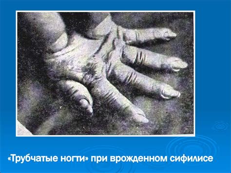 Врожденный сифилис - презентация онлайн