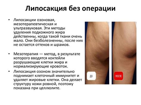 Липосакция - презентация онлайн