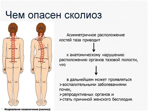 Сколиоз 3 степени: причины, симптомы, лечение