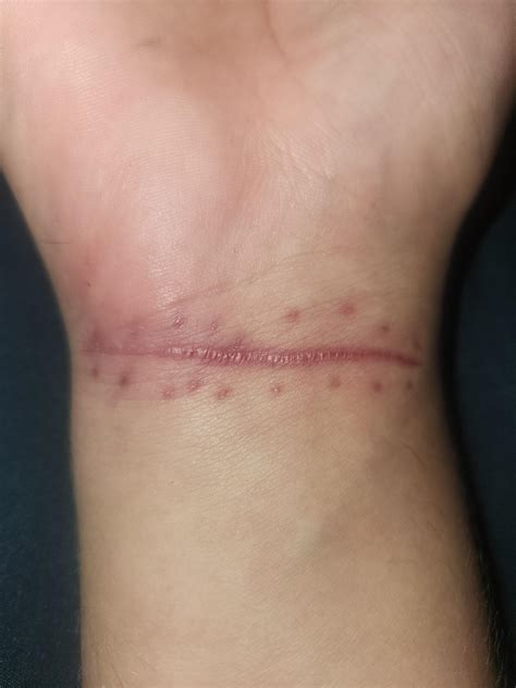 (SH Scar) I've seen others with a some types of scars but not exactly ...