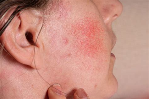 Skin Rash - RapidCare Emergency Room - Safe, Fast & Open 24/7 - Free ...