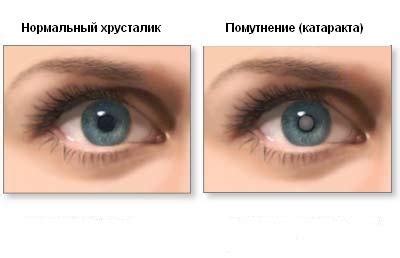 Катаракта