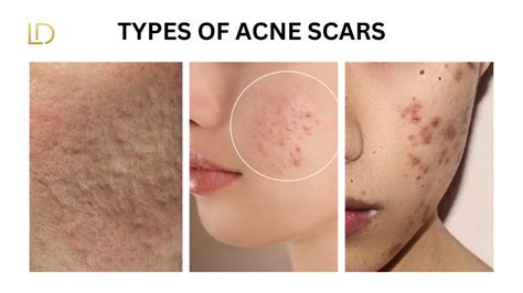 acne scars  face
