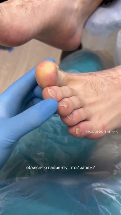 ГРИБОК СТОП И НОГТЕЙ 🦶🏻 #грибокногтей #грибок #подолог #педикюр #микоз ...