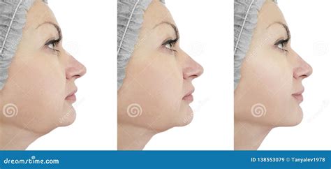 Woman Chin Lift before and after Procedures Stock Image - Image of loss ...
