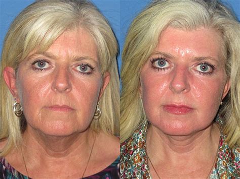 Lower Facelift Guide: What Are They, Cost, & Recovery