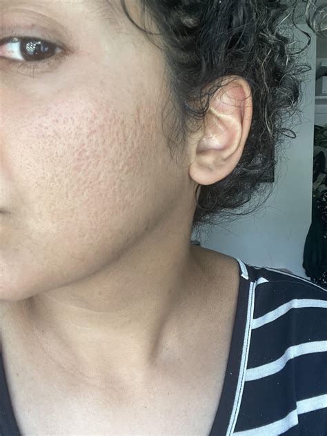 How to safely get rid of this acne scarring texture? : r/30PlusSkinCare