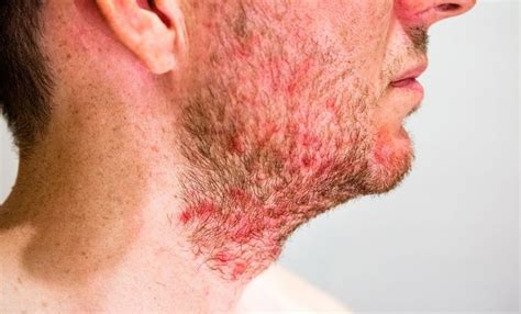 Seborrheic Dermatitis: Rough Red Rash on the Face