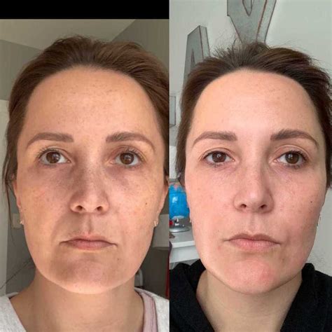 Prescription Wrinkle Cream Reviews | Anti-Aging Tretinoin Cream and ...