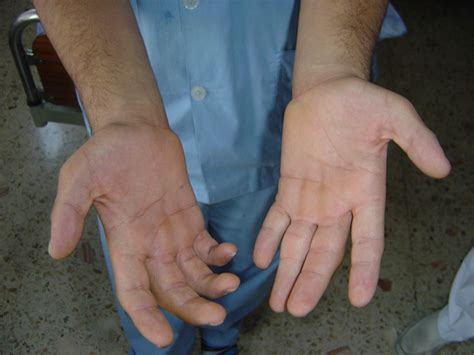 tenar  hypothenar atrophy  scientific diagram