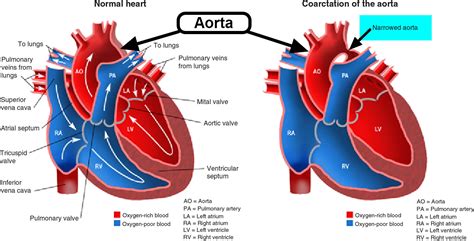 Coarctation of Aorta - In Infants - Symptoms, Murmur, Surgery