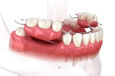 difference   temporary prosthesis   final