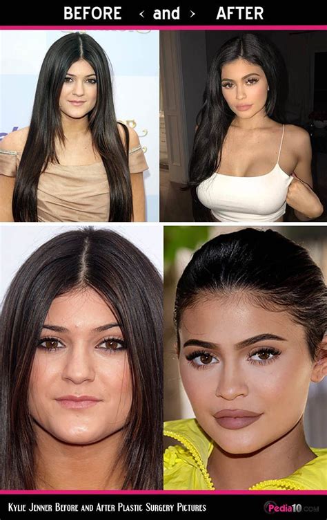 Kylie Jenner Before And After Face . Kylie Jenner Before And After ...