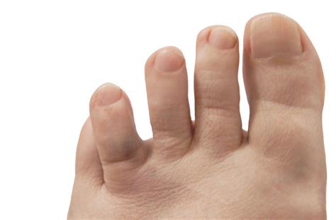 toe fractures rarely require surgery