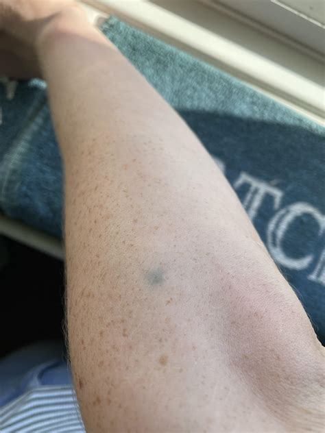 Dark Spots On Upper Arm at Alice Hager blog