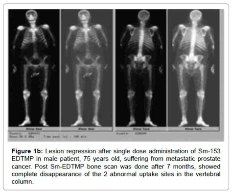 The Optimal Efficacy of a Single Therapeutic Dose of Sm- 153 EDTMP in