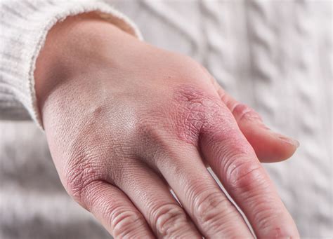 Alguns Fungos Causam Doenças Como Frieira E Micose