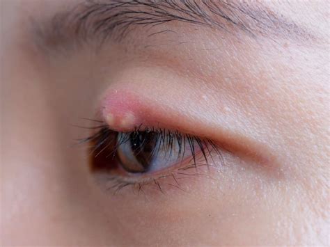 Infekcija oka : Simptomi, Uzroci, Komplikacije, Lečenje, Prevencija