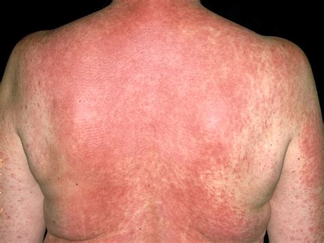 Medical Reaction Rash at Eileen Perry blog