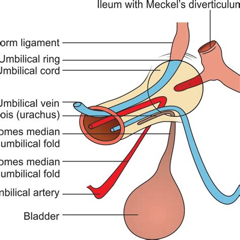 3: Abnormalities of Omphalomesenteric duct | Download Scientific Diagram