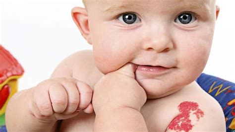 Strawberry Birthmark, Pictures, Meaning, Myths, Causes, Removal ...