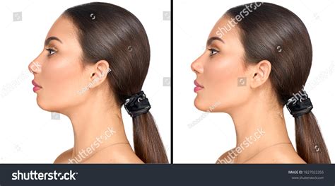 Receding chin Images, Stock Photos & Vectors | Shutterstock