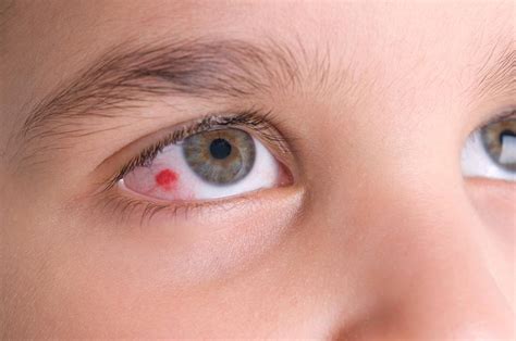 common eye injuries    treat