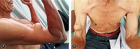 A case of Popeye. A 72‐year‐old male, farmer, no obvious traumatic ...