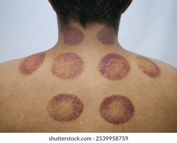 marks  cupping