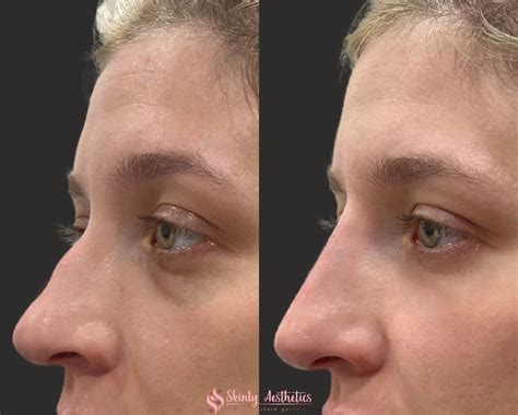 Non-Surgical Rhinoplasty - Before and After Results