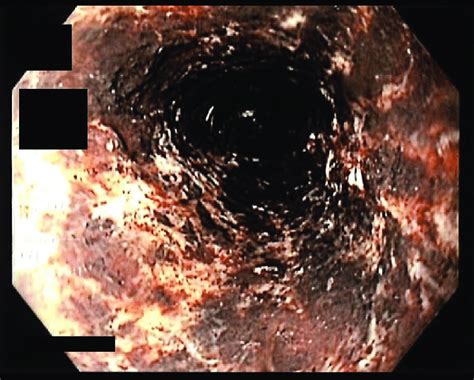 esophagogastroduodenoscopy egd exposing  necrotic esophageal mucosa