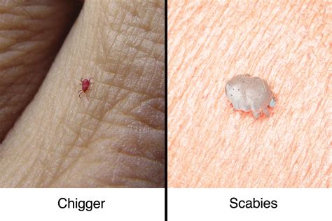 Scabies Bite Marks