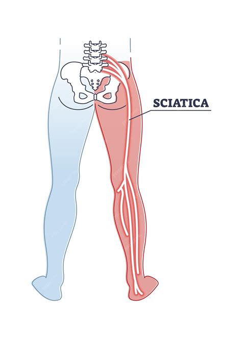 Premium Vector | Sciatica pain or nerve weakness as leg lumbar