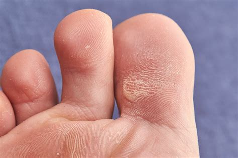 Male Toe Legs With Rough Skin On Blue Fabric Close Up Stock Photo ...