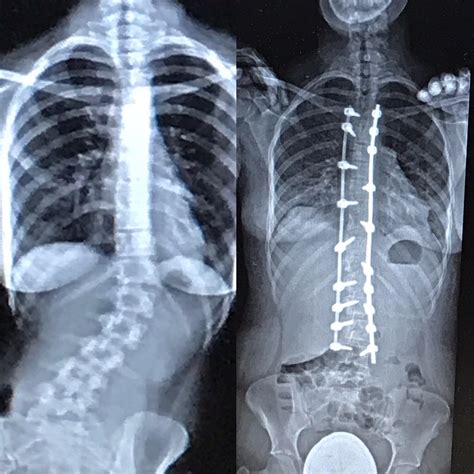 Before and after pics from my surgery (6/26/19) : r/scoliosis