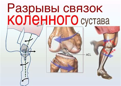 Разрыв связок коленного сустава: симптомы, лечение, код МКБ-10 и ...