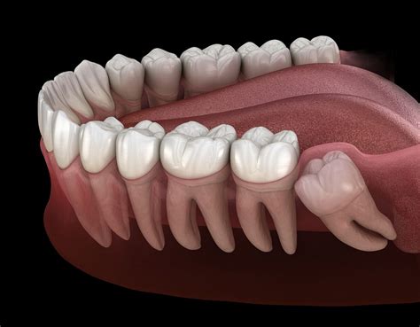 Зуб мудрости. Осложнения | DENTAL-INFO
