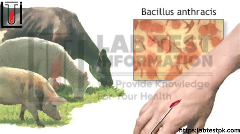 Anthrax Disease