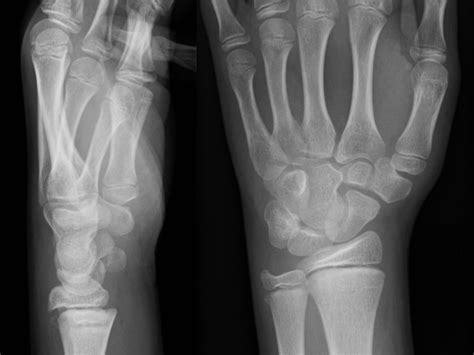 bone  bone fractures teaching resources