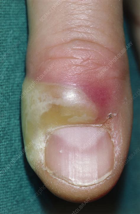 paronychia   fix  infected fingers link primary care