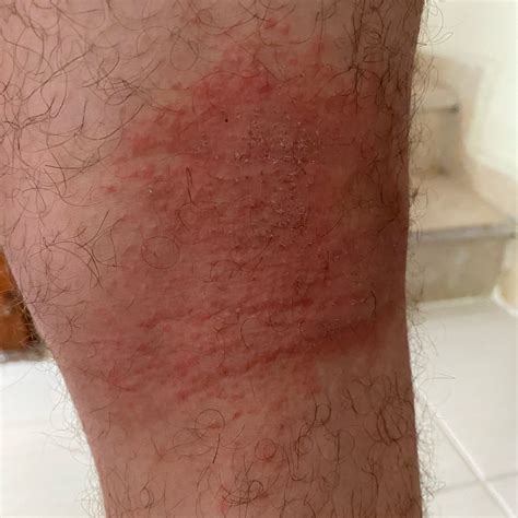 Peanut Oil Atopic Dermatitis at Greg Booth blog