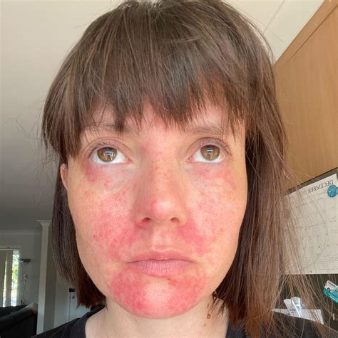 Red, burning, itchy, rough skin getting worse : r/DermatologyQuestions