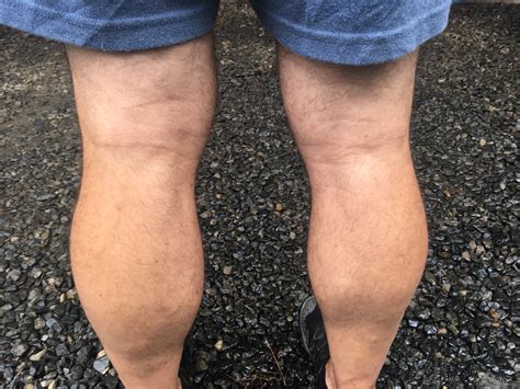 Bakers Cyst Football Coach