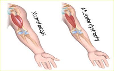 Muscular Dystrophy- Symptoms,Causes,Types,Diagnosis and Treatment