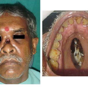 Palatal feeding obturator retained with Adams clasp | Download ...