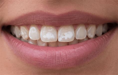 Pontinho Branco No Dente - Mancha Branca nos Dentes: Causas e Como Tratar - MAXICLIN